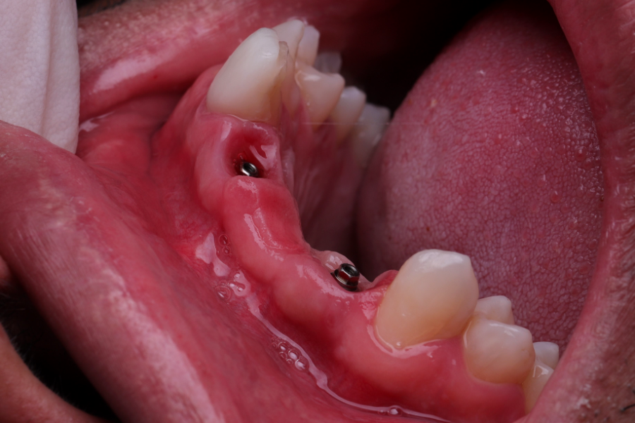 Implantes