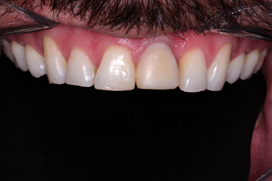 Antes